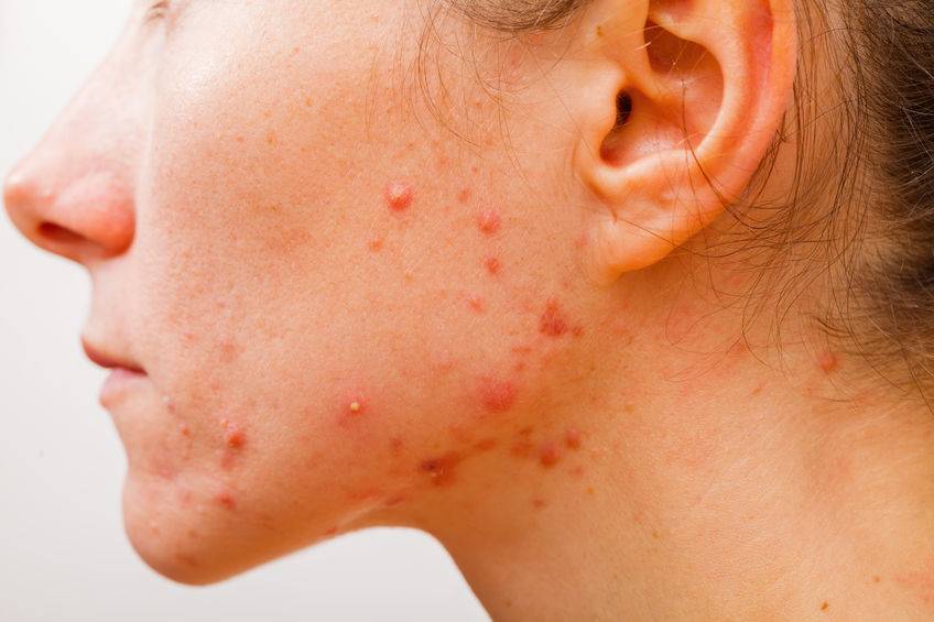 脸上反复长痘，或与这4个因素有关，找到诱因后，需针对治疗